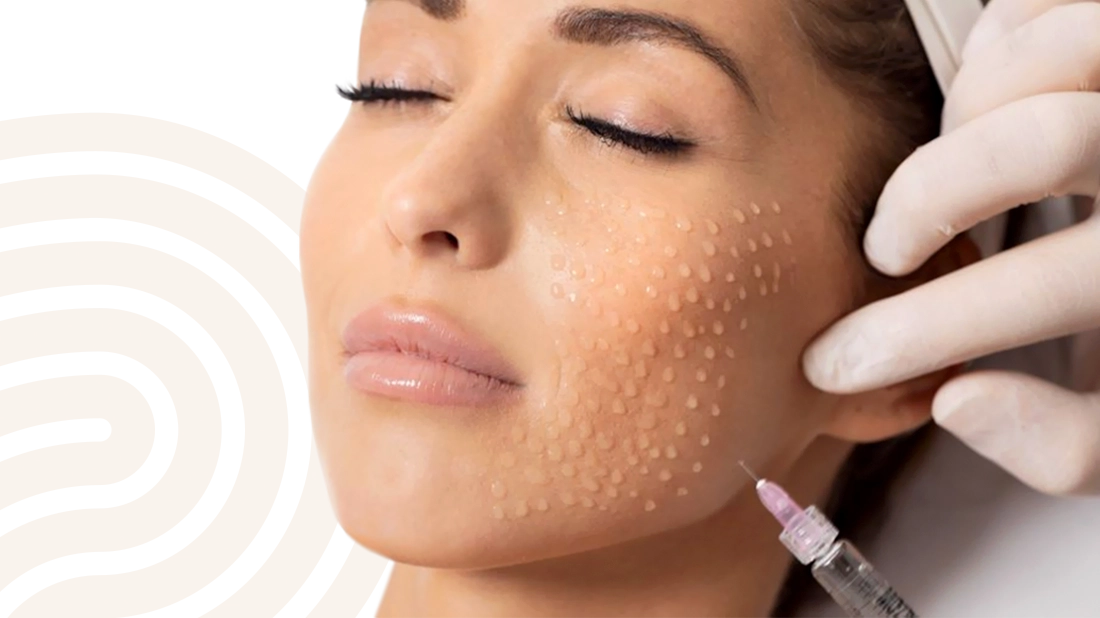 Injekčná biorevitalizácia pleti kyselinou hyalurónovou, Dermarevolta Bratislava