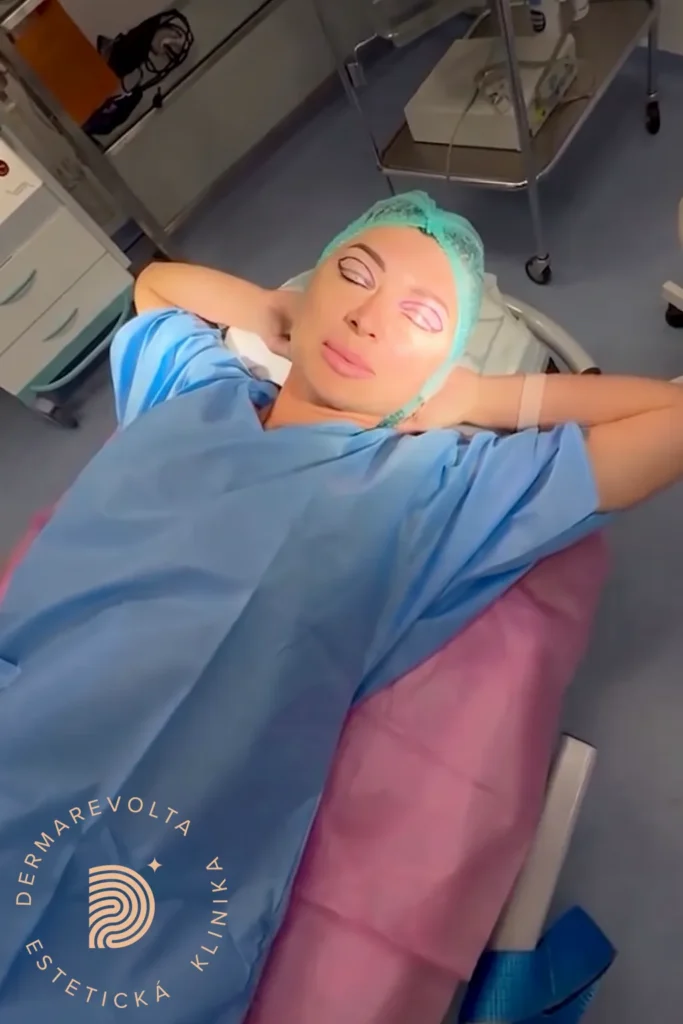 Pacientka ležiaca na operačnej sále s precíznym predoperačným značením na viečkach, pripravená na plastiku očí.