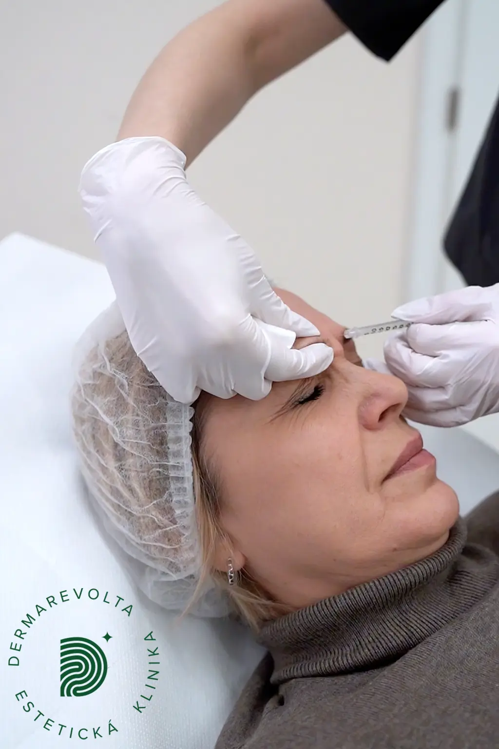 Aplikácia botulotoxínu na odstránenie mimických vrások medzi obočím na klinike Dermarevolta v Bratislave