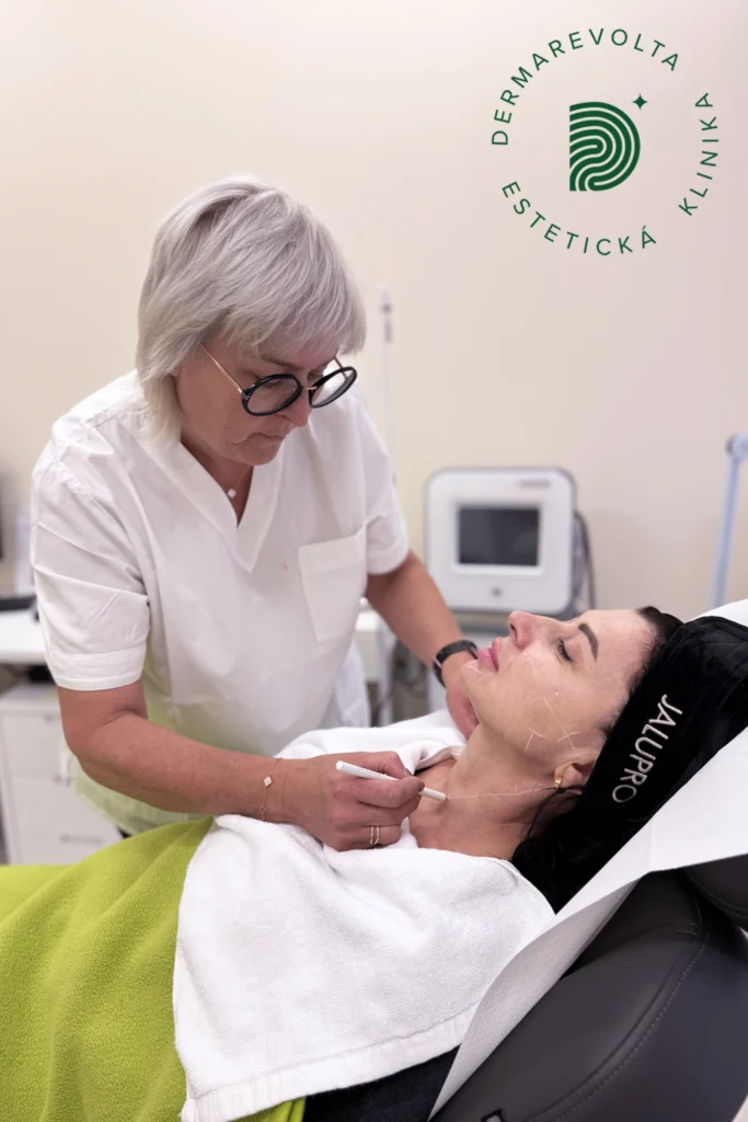 Profhilo aplikácia body na tvári označenie pred zákrokom omladenie pleti Bratislava