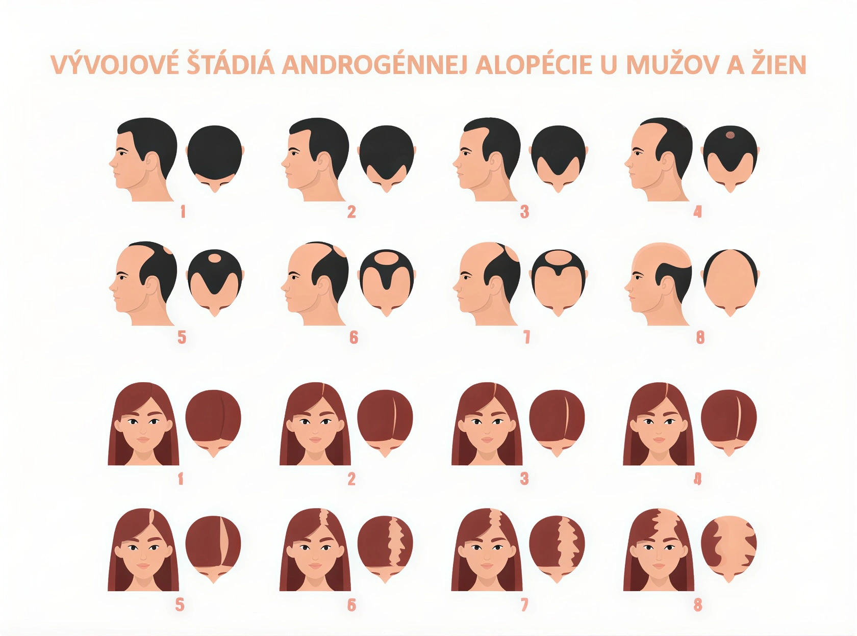 stadia androgennej alopecie u muzov a zien