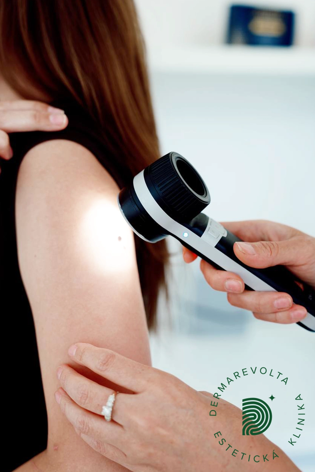 Odborná digitálna diagnostika znamienok na ruke moderným ručným dermatoskopom na klinike Dermarevolta