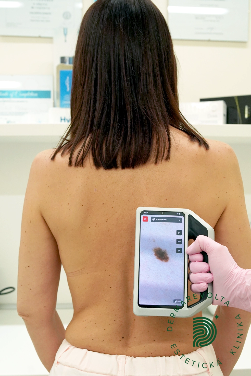 Pokročilá celotelová kontrola znamienok na chrbte pacientky, detail zväčšeného podozrivého névu na obrazovke dermatoskopu