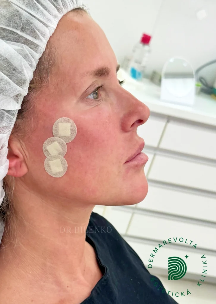 Okamžitý efekt po niťovom liftingu COG niťami v profile u lekárky Bilenko na klinike Dermarevolta Bratislava
