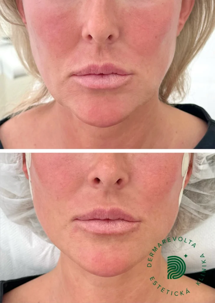 Výsledok pred a po niťovom liftingu tváre spredu – vyhladenie nasolabiálnych rýh a spevnenie pleti mezonitami na klinike Dermarevolta
