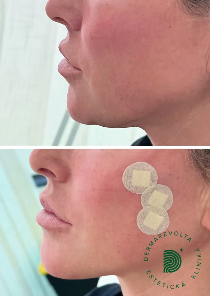 Porovnanie pred a po niťovom liftingu tváre v profile so zameraním na spevnenie sánky a podbrádka v Bratislave
