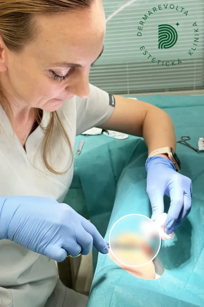 Lekár vykonáva odstránenie lipómu počas ambulantného zákroku na klinike v Bratislave