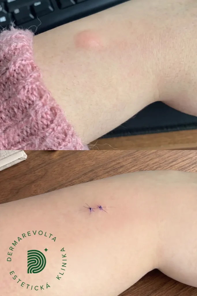 Odstránenie lipómu na nohe – výsledok po chirurgickom zákroku Dermarevolta Bratislava