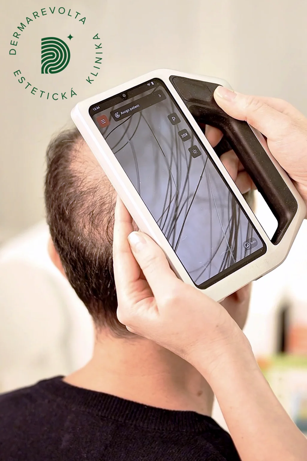 Digitálna trichoskopia vlasovej pokožky pri diagnostike rednutia vlasov u muža na klinike Dermarevolta