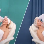 Niťový lifting vs. botox: Aký je medzi nimi rozdiel a čo môže byť vhodné pre vás?