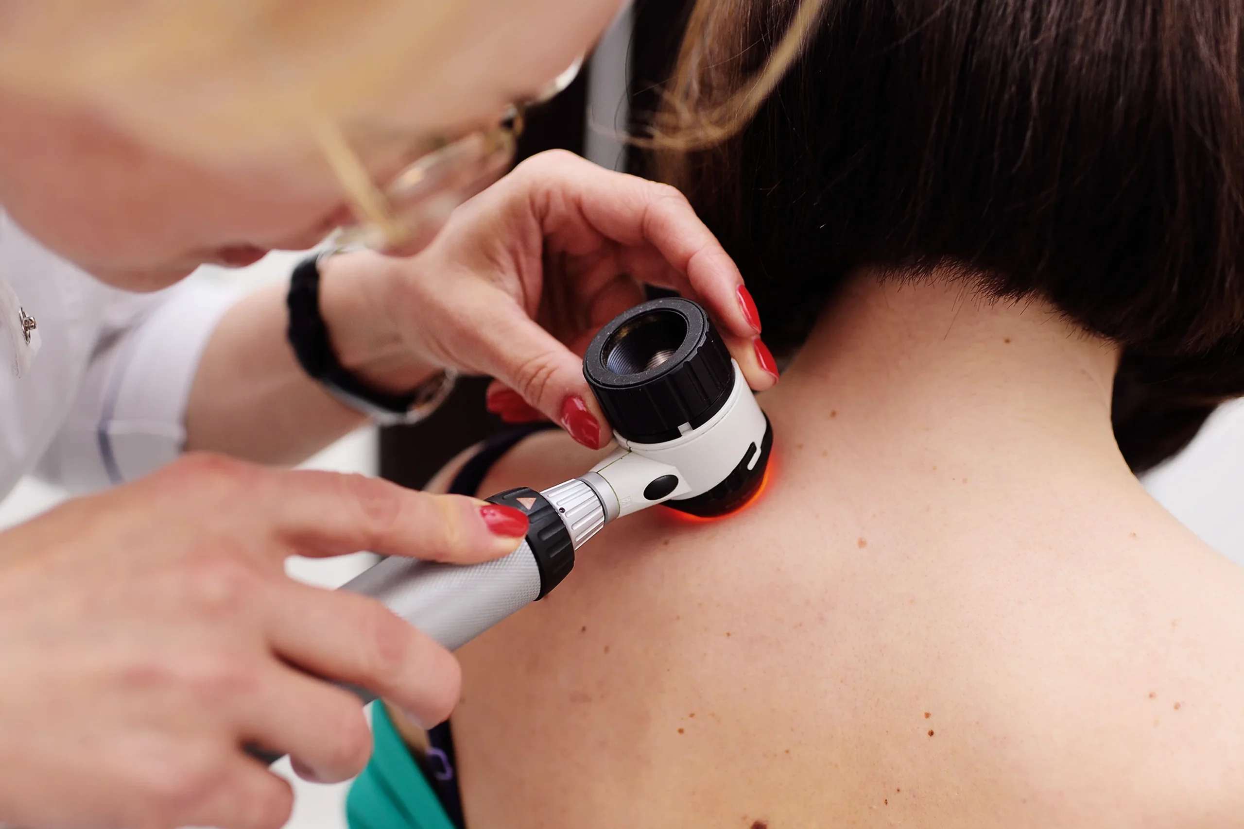 Dermatolog vysetruje znamienka na kozi chrbta pomocou dermatoskopu na diagnostiku melanomu