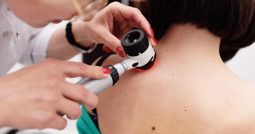 Dermatolog vysetruje znamienka pomocou dermatoskopu na diagnostiku melanomu