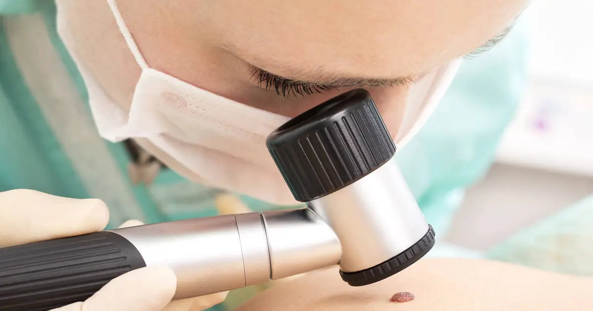 Dermatológ vyšetruje znamienko dermatoskopom