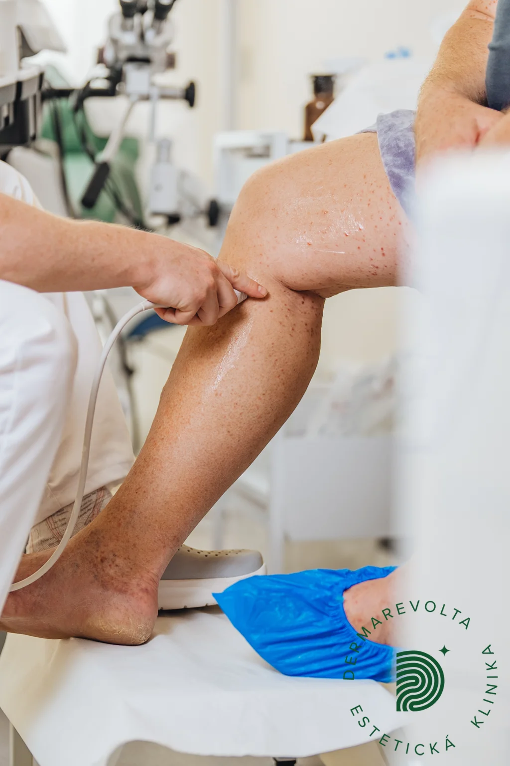 Ultrazvukové vyšetrenie žíl dolnej končatiny v klinike Dermarevolta