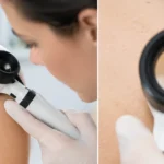 Melanóm štádiá a prognóza: čo ovplyvňuje ďalší postup liečby
