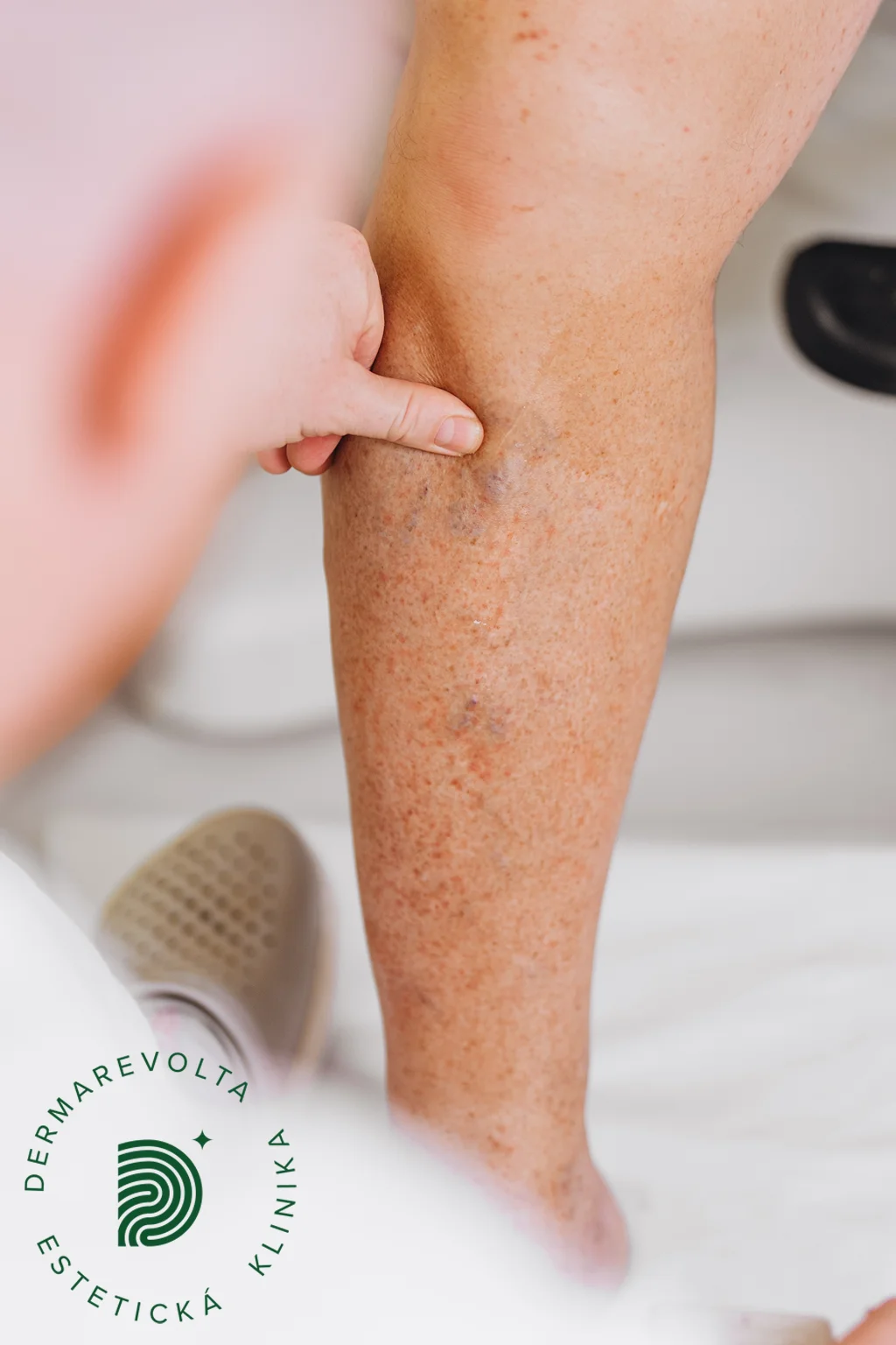Lekár vyšetruje žily dolnej končatiny pacienta na klinike Dermarevolta