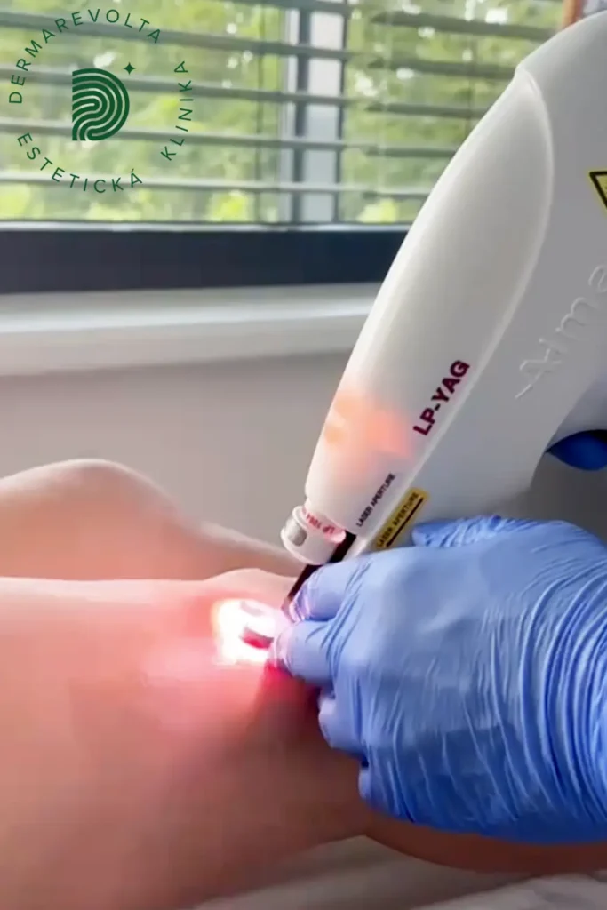 Laserové odstránenie cievnych metličiek na nohách na klinike Dermarevolta