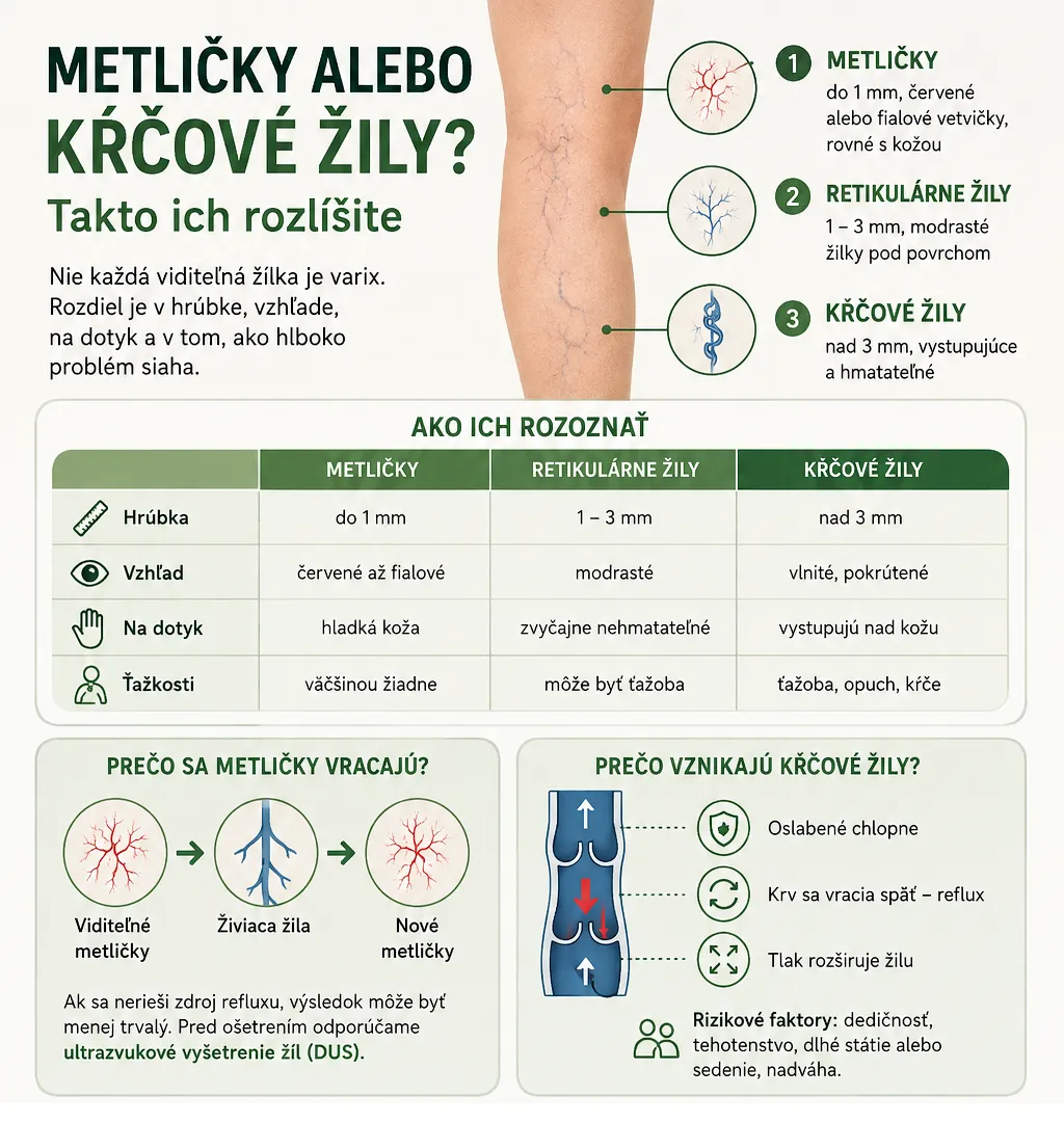 Infografika: rozdiel medzi metličkami, retikulárnymi a kŕčovými žilami