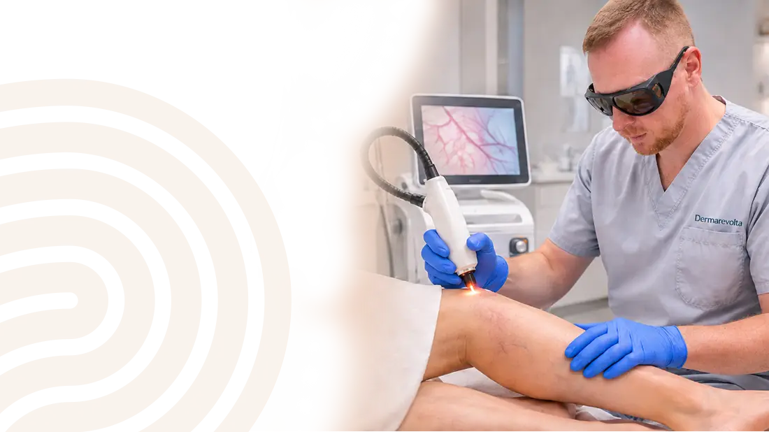 Odstránenie cievnych metličiek laserom na nohách v Bratislave