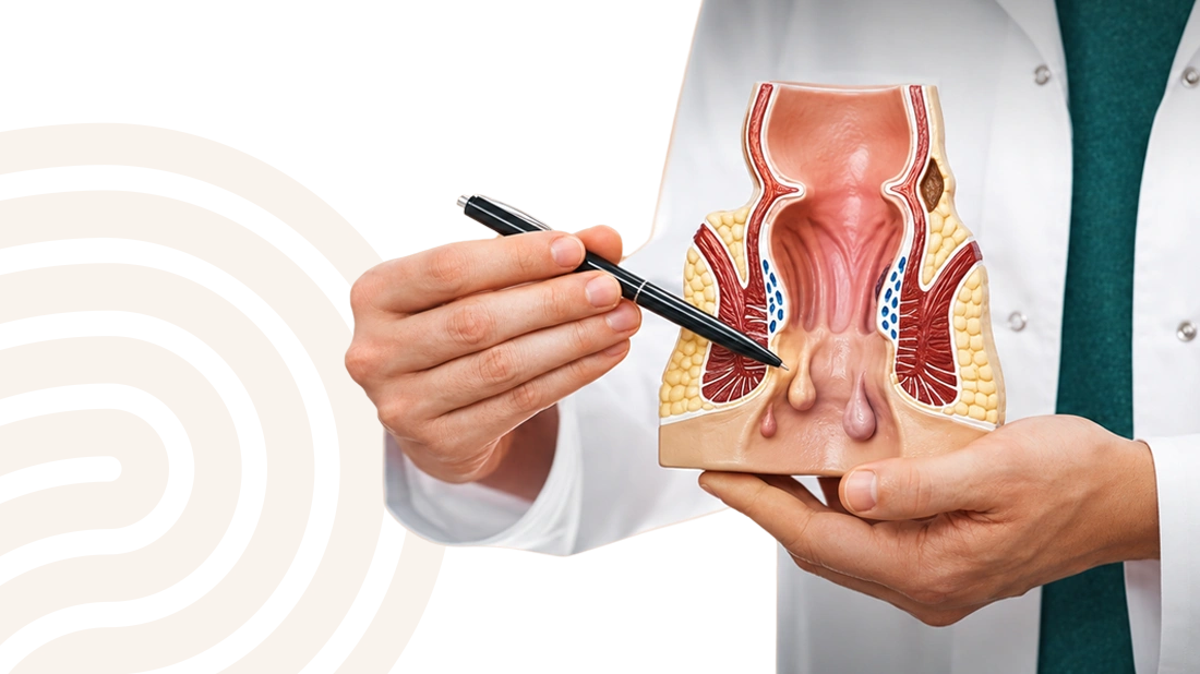 Odstránenie análnych duplikatúr – anatomický model konečníka