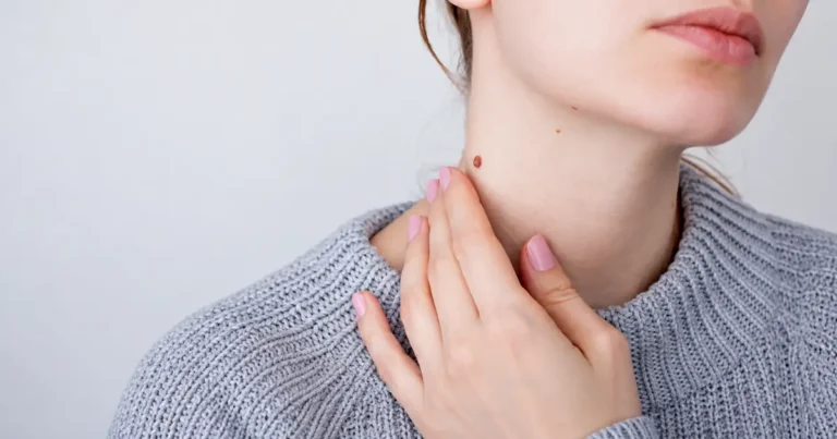Samovyšetrenie znamienok doma: praktický postup a kedy ísť k dermatológovi